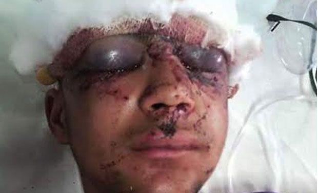 Expert doctors from Mumbai conduct surgeries on pellet injured at SMHS